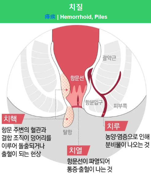 치질의 종류