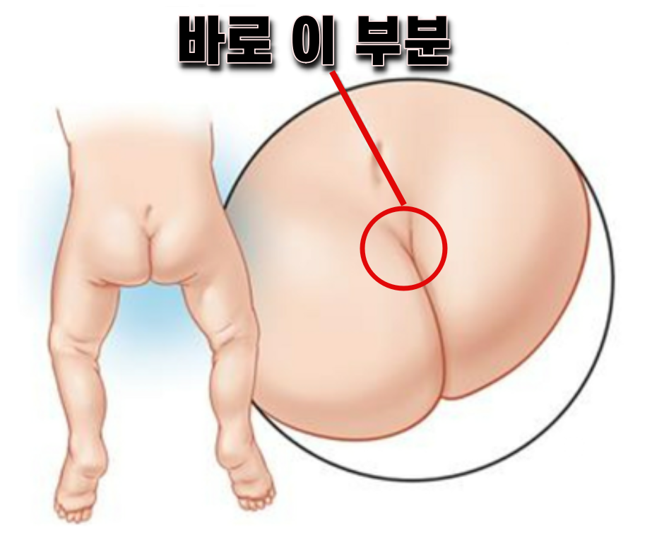 치질 운동